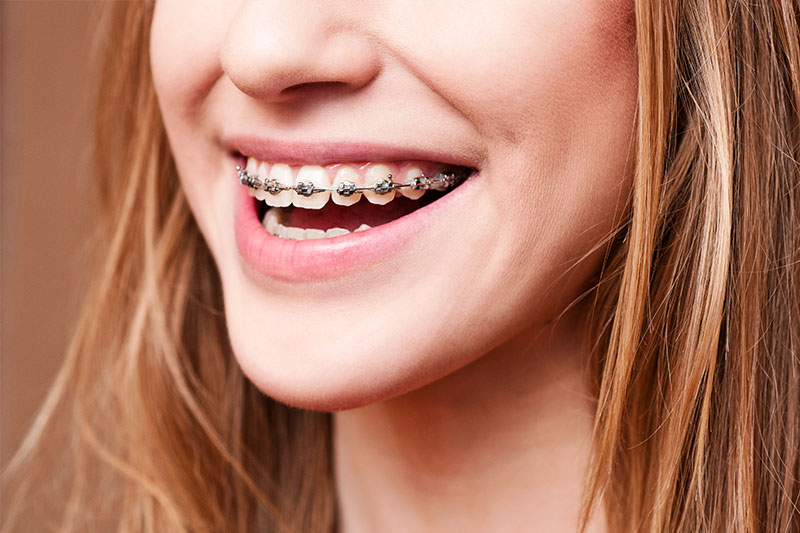 Orthodontics in Azusa