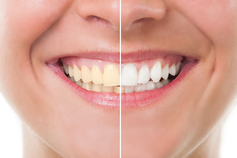 Teeth Whitening in Azusa
